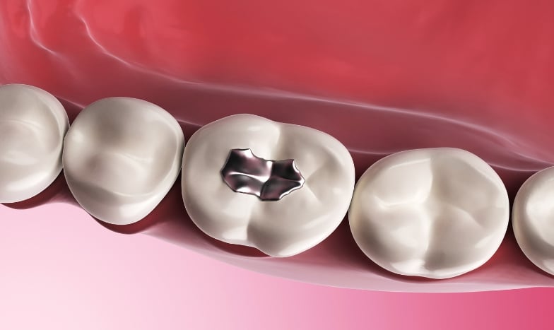 Featured image for “Why Composite Fillings Are A Top Choice”