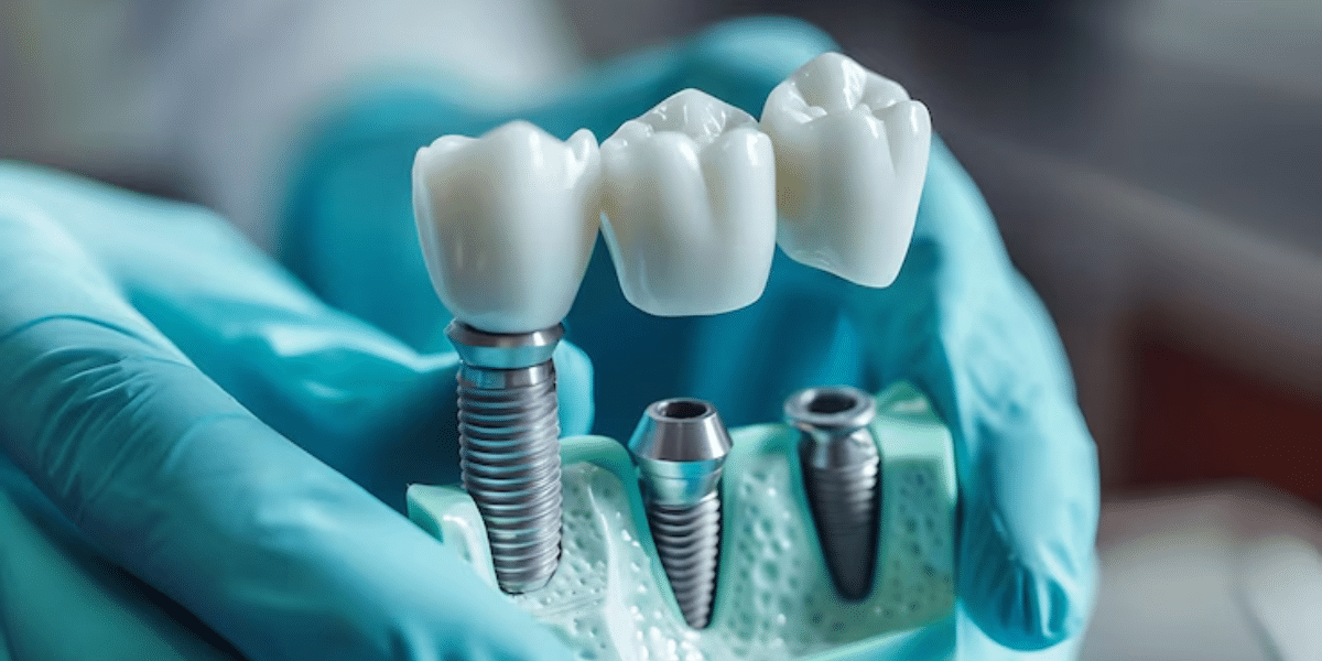 how to choose the best dental implant specialist