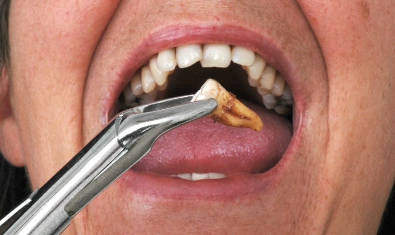 Featured image for “Which Tooth Extraction Is The Most Painful?”