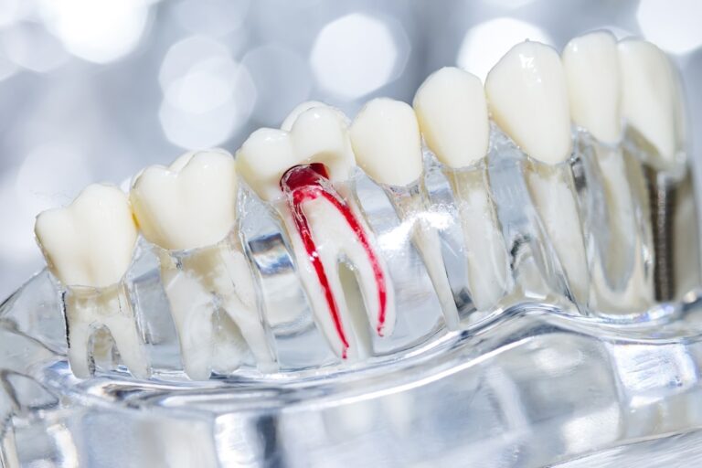 Root Down Riverside Root Canal vs. Fillings: Key Differences Explained