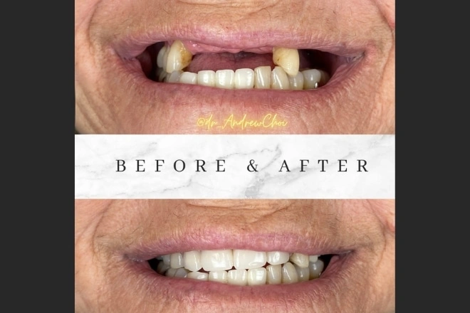 img-Are-Dental-Implants-Your-Ultimate-Solution_