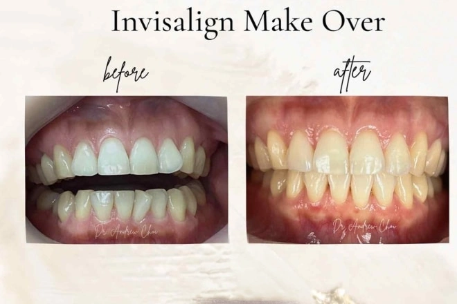 img-Invisalign 22